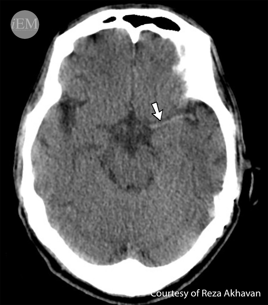 CT Scans and Their Importance in Stroke Diagnosis