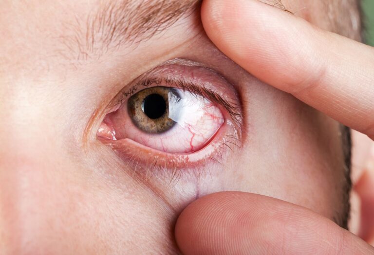 Common Eye Conditions Explained: Symptoms, Causes, and Treatment Options!