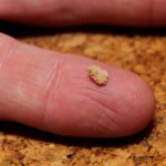 Exploring Modern Technologies for Breaking Down Kidney Stones