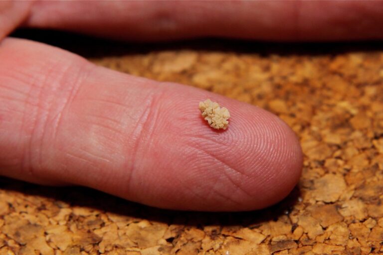 Exploring Modern Technologies for Breaking Down Kidney Stones