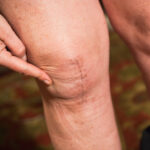 How a Knee Replacement Can Improve Mobility and Quality of Life