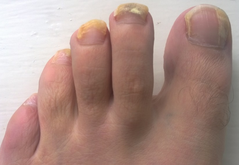 Understanding the Lifecycle of Fungal Nail Infections