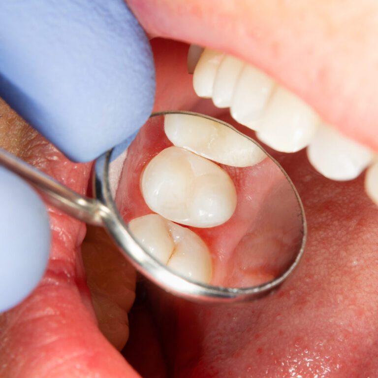 Why Regular Cleanings are Key to Cavity Prevention