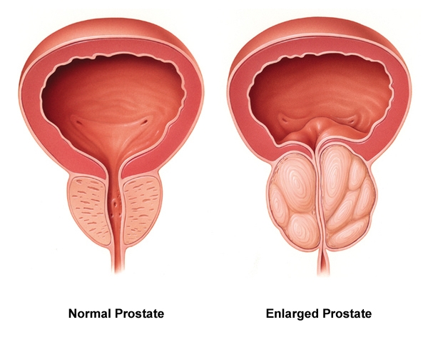 3 Benefits of Enlarged Prostate Treatments