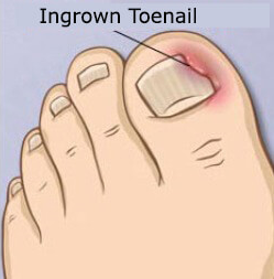 Early Intervention for Ingrown Toenails