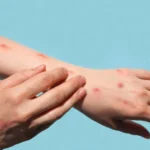 How Allergy Shots Can Help You Live a Better Allergy-Free Life