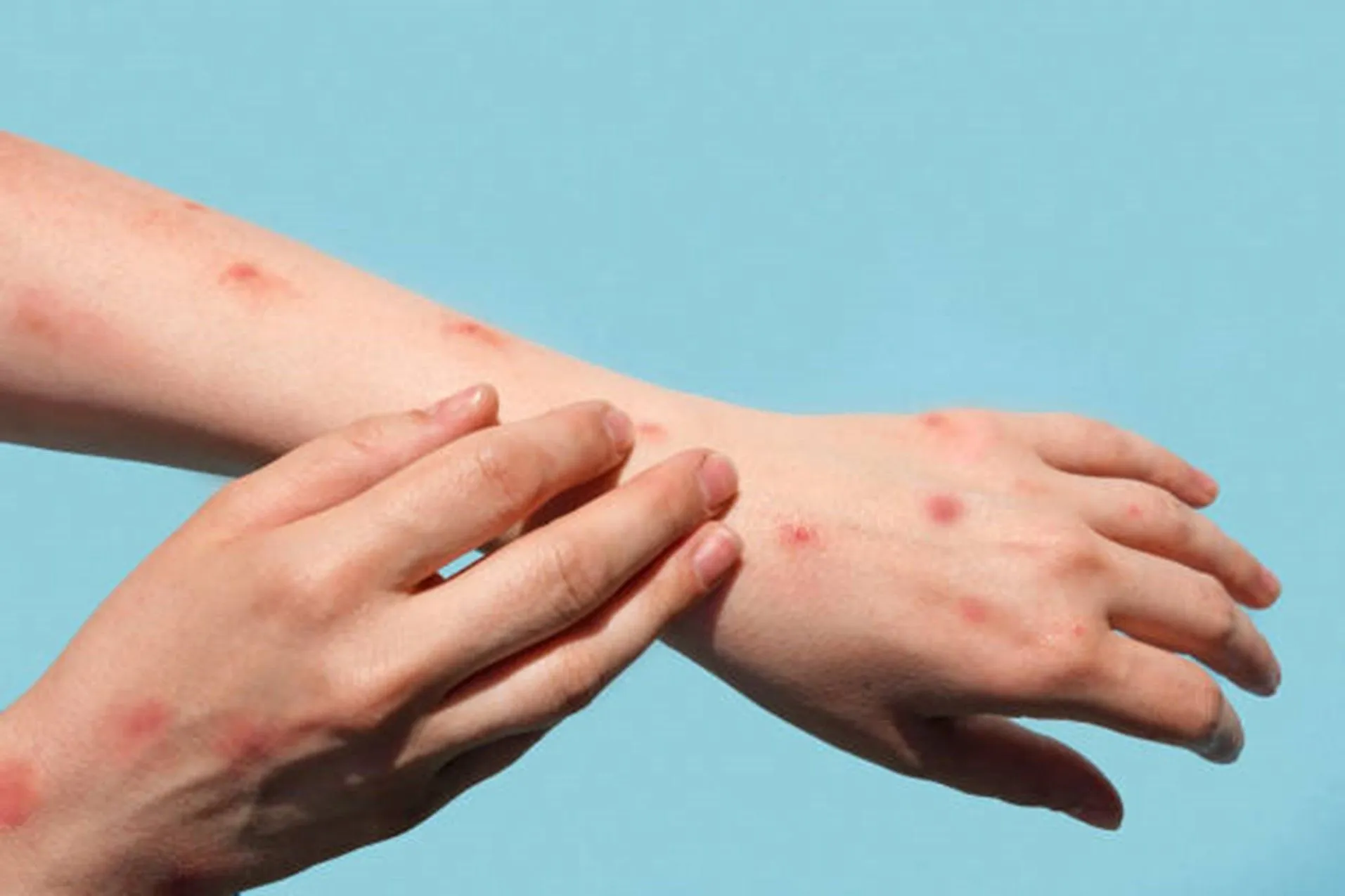 How Allergy Shots Can Help You Live a Better Allergy-Free Life