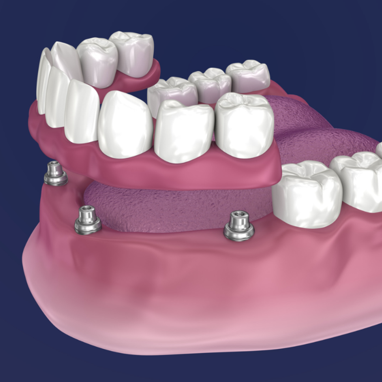 How to Care for New Dental Implants