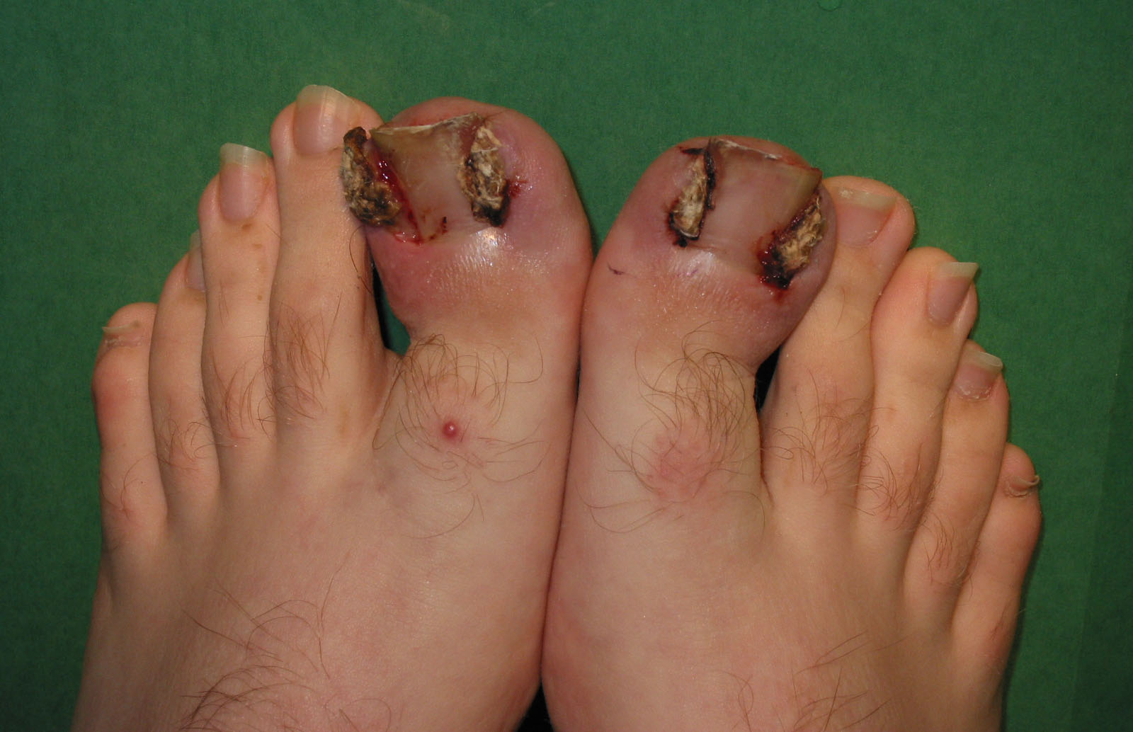 How to Prevent Ingrown Toenails