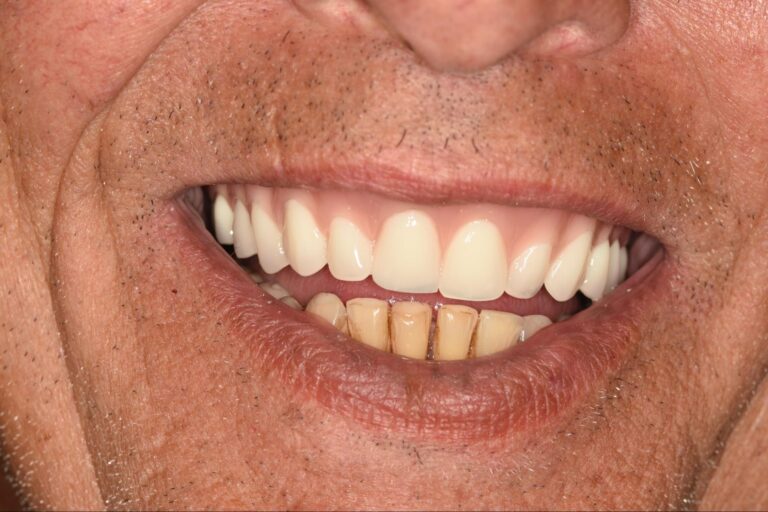 Implant Maintenance Tips for Longevity