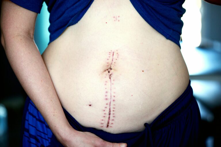 Post-Surgery Care Tips for a Smooth Recovery After Tubal Reversal