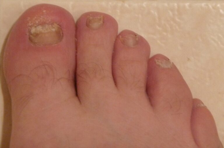 The Dangers of Foot Fungus and How To Protect Your Feet