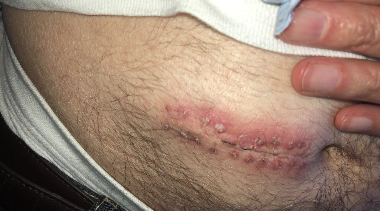 The Importance of Moisture Balance in Wound Healing