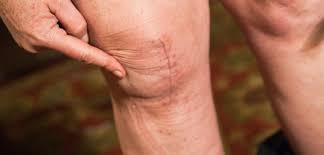 The Link Between Diet and Arthritis Management