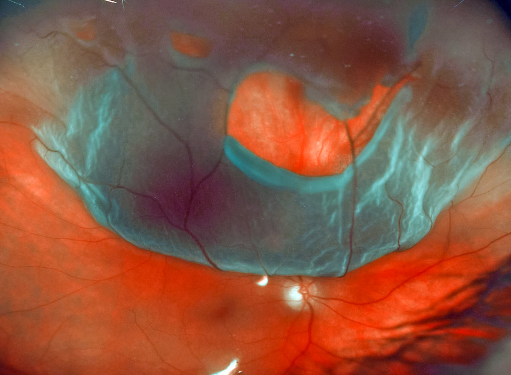 Treatments for Retinal Detachment