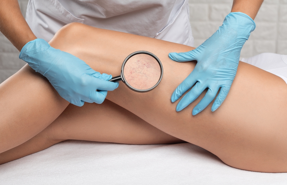 Understanding the Causes and Symptoms of Varicose Veins
