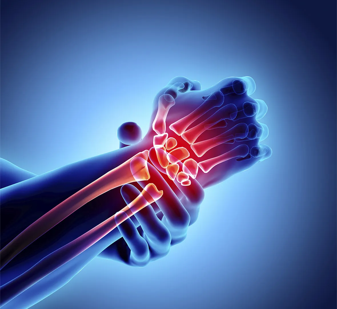Understanding the Impact of Cartilage Loss on Mobility