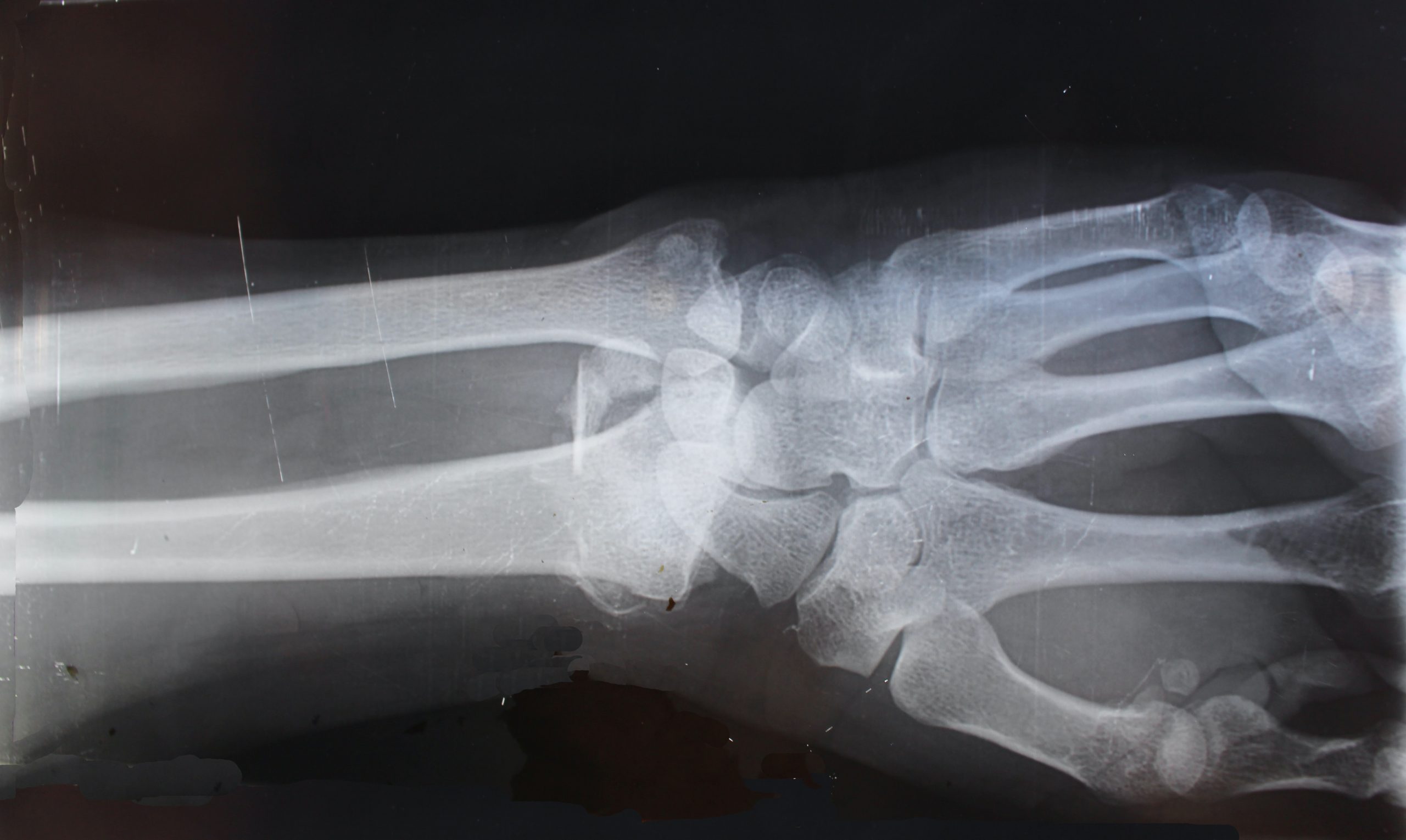 Understanding the Role of X-rays in Diagnosing Bone Conditions