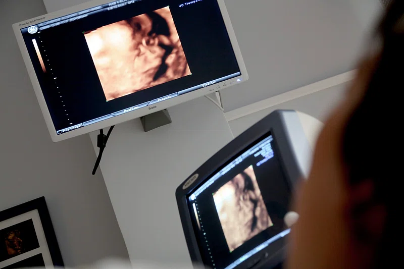 What To Expect From a 3D Ultrasound