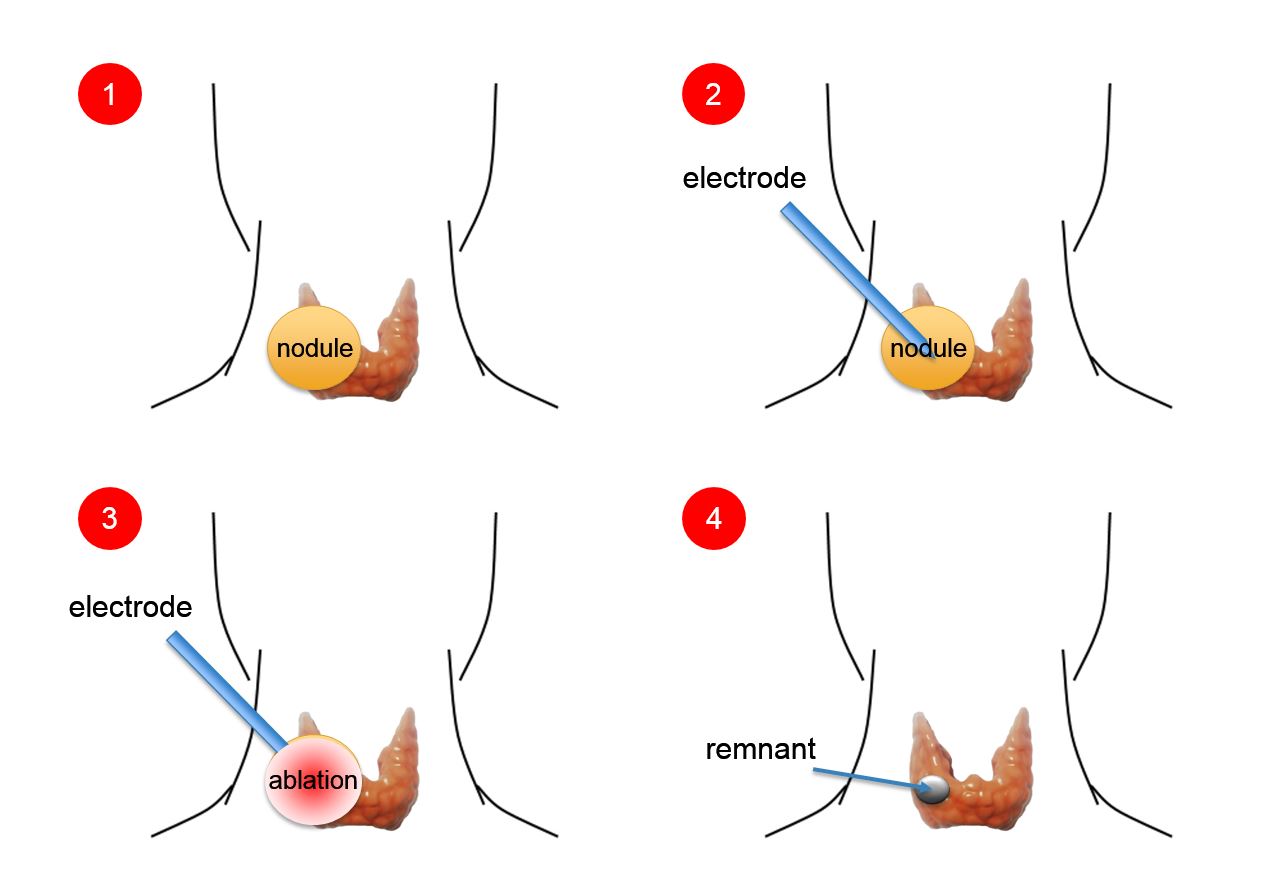 What to Expect During and After a Thyroid Radiofrequency Ablation