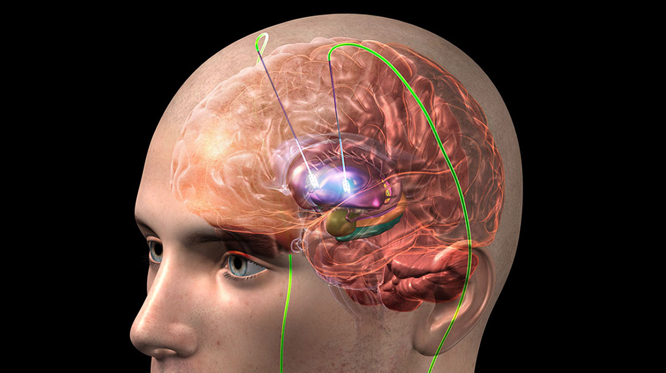 When Should You See a Neurologist About Tremors?