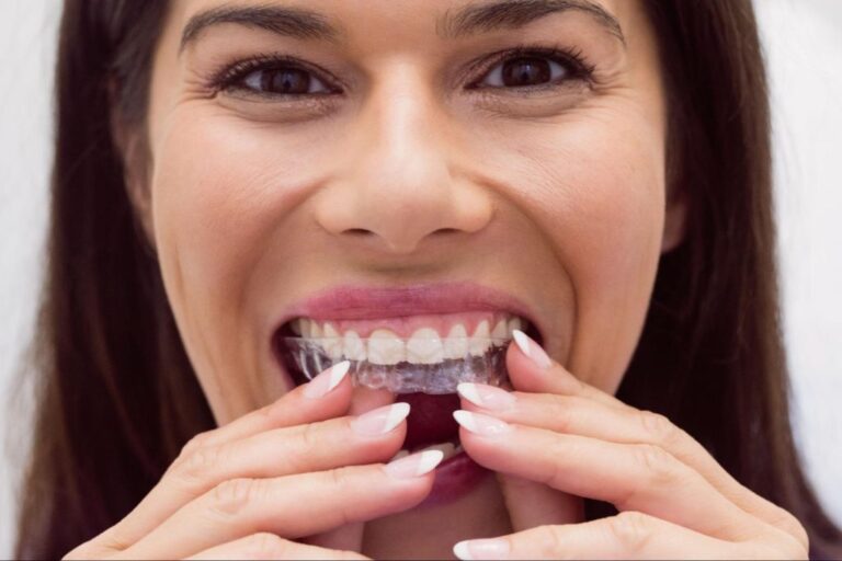 Why Clear Aligners Are a Good Option for Teenagers