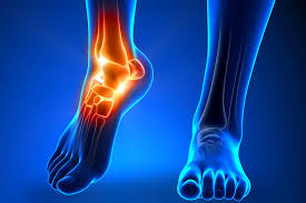 Why Diabetic Neuropathy Requires Early Intervention