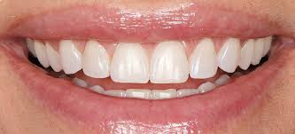 3 Questions To Ask During Your Teeth Cleaning