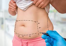 A Comprehensive Guide to Hernia Repair Surgery: Before, During, and After