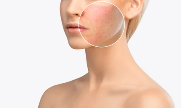 Acne Treatment: Addressing Cystic Acne with Homeopathic Treatments