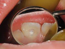 Benefits of Regenerative Endodontics