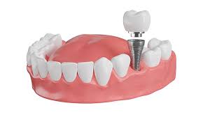 Dental Implants Versus Dentures