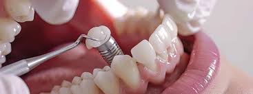Exploring the Different Types of Dental Restoration Treatments Available