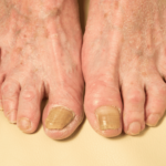 Natural Treatments for Toe Nail Fungus