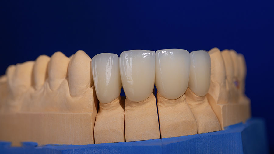 The Role of Crowns in Restoring Dental Aesthetics