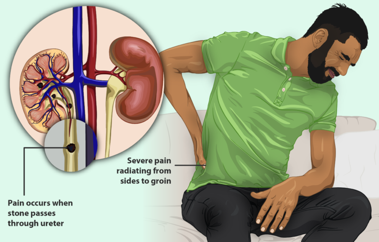 Common Questions About Kidney Stones