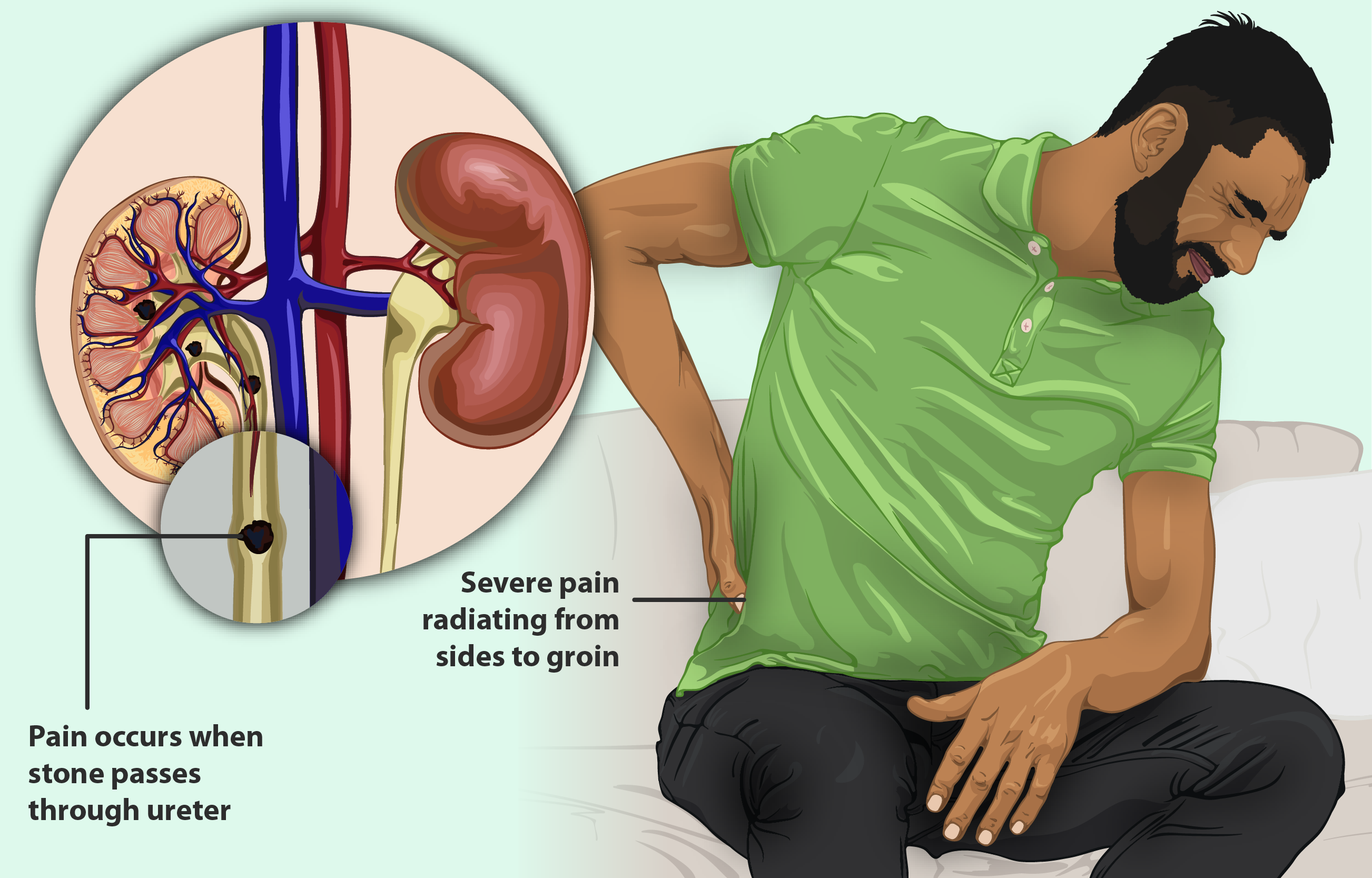 Common Questions About Kidney Stones