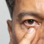 How to Prepare for Cataract Surgery