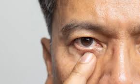 How to Prepare for Cataract Surgery