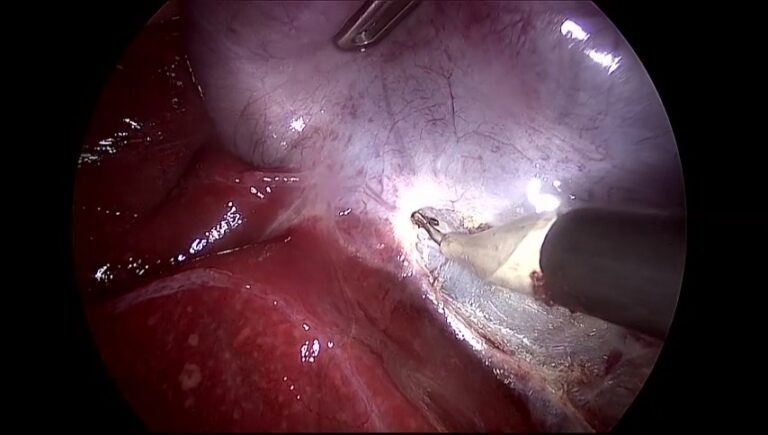 Preparing for Your Gallbladder Removal Surgery