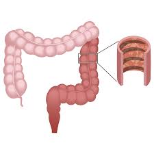Ulcerative Colitis Treatment Options