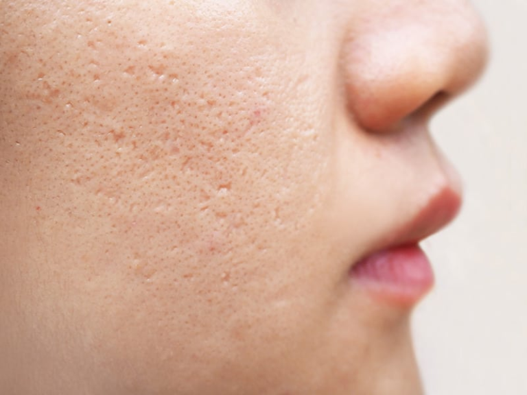 How to Remove Acne Scars Naturally