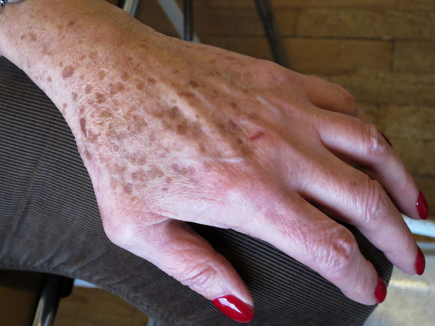 Recognizing the Symptoms of Eczema