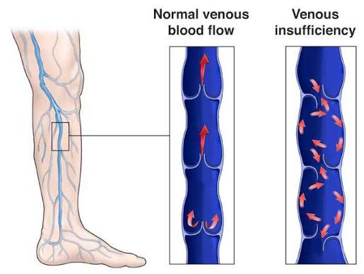 Understanding the Symptoms and Diagnosis of Chronic Venous Insufficiency