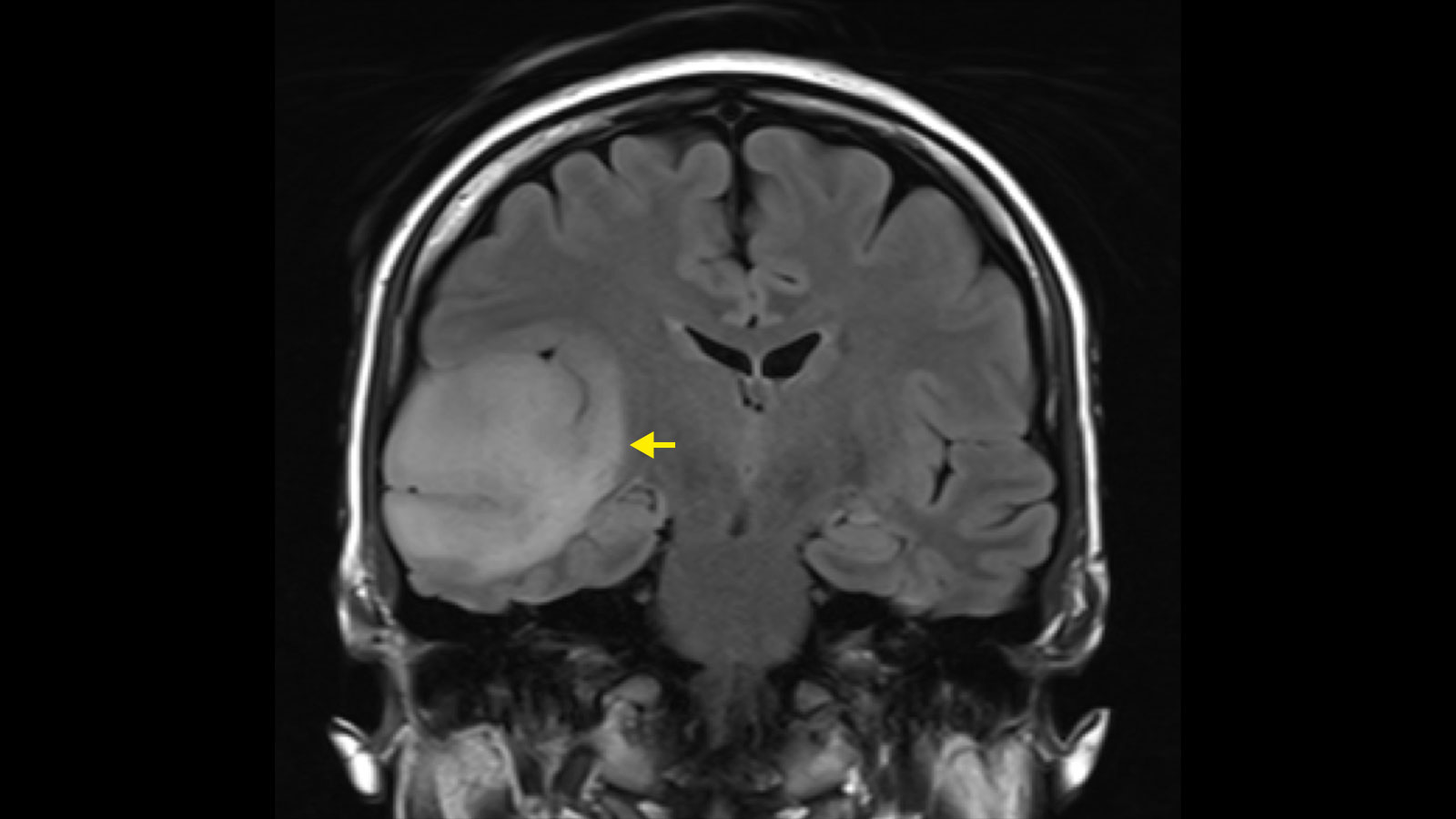 What You Need To Know About Life With Acoustic Neuroma