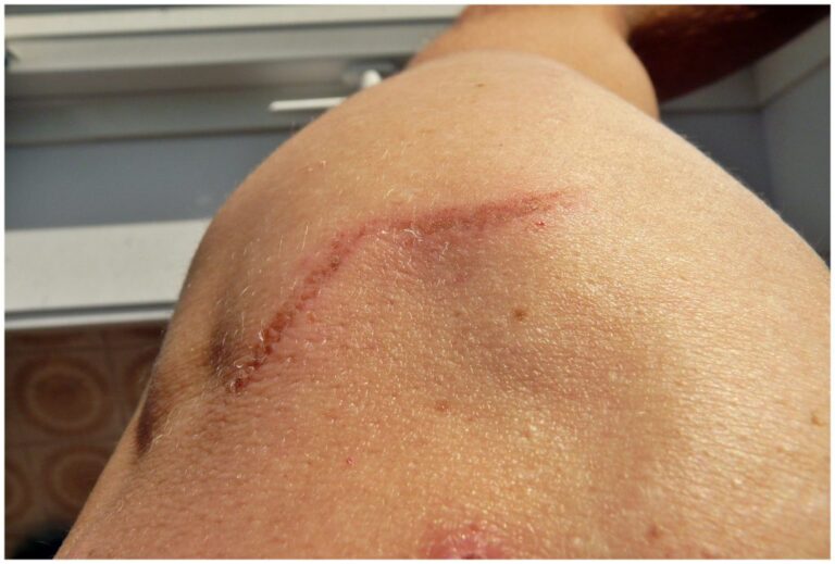 What You Should Know About Aftercare for Laser Tattoo Removal